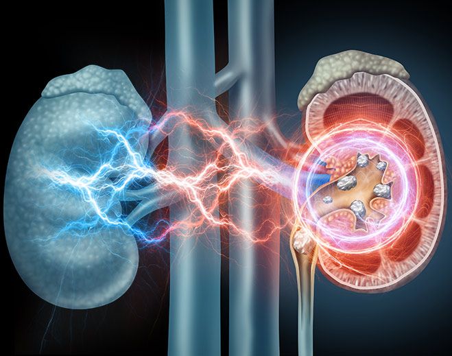 shock wave lithotripsy